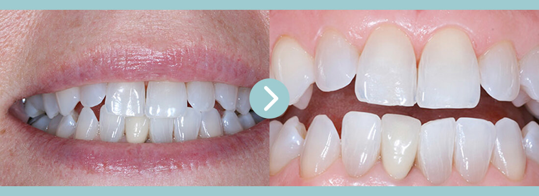 Procelain_Veneers-001 (1)