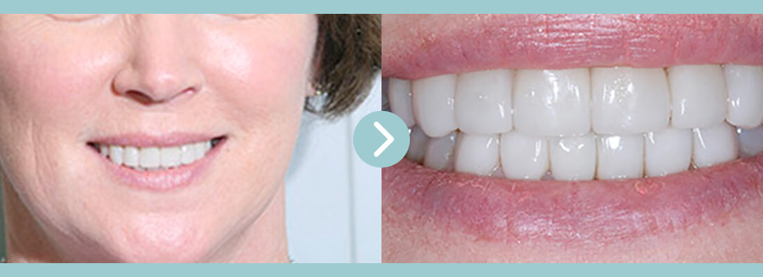 Procelain_Veneers-002