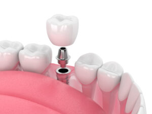 Dental implants Cary